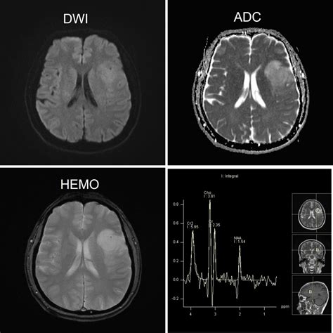 Low Grade Glioma Radiology Cases