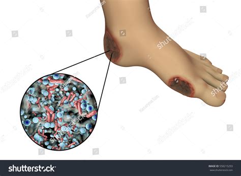 Diabetic Foot Infection Close-up View Bacteria Stock Illustration ...