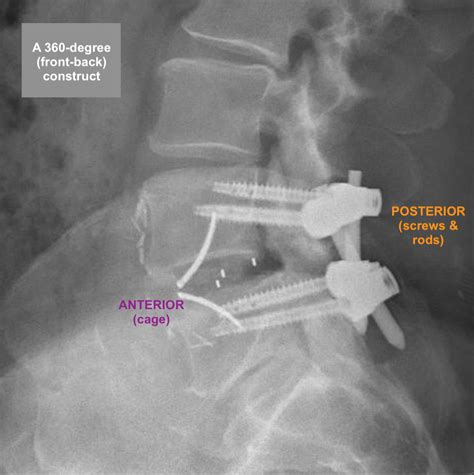 360 Degree Front Back Surgical Reconstruction Of Isthmic And