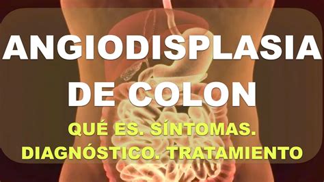 Angiodisplasia de colon Qué es diagnóstico y tratamiento YouTube