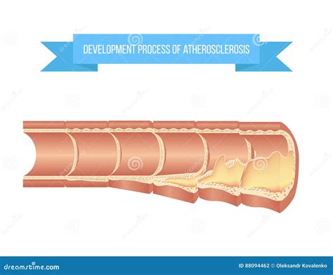 Atherosclerosis Process On Different Stages From Healthy Vessel To