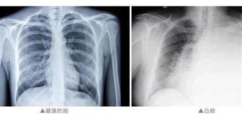 “阳康”痊愈吗？哪些情况要做肺部ct？有基础病的老年人也应接种新冠疫苗吗？专家权威解读手机新浪网