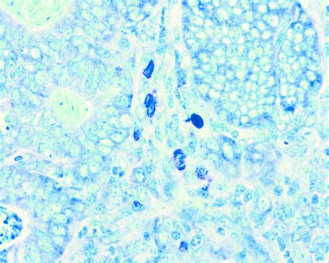 Mast Cells Within Adenocarcinoma Toluidine Blue Staining Original