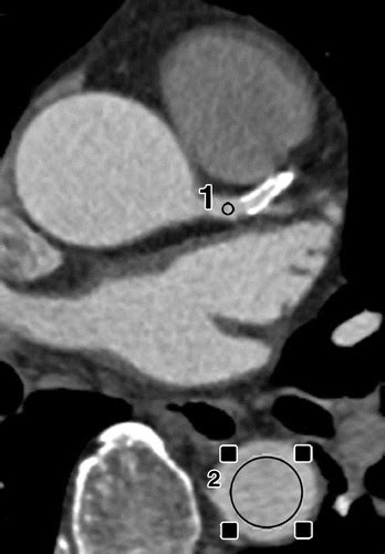 Coronary In Stent Restenosis Assessment With Corrected Coronary