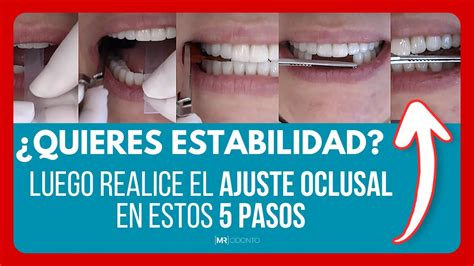 Los Pasos Del Ajuste Oclusal Estable Youtube