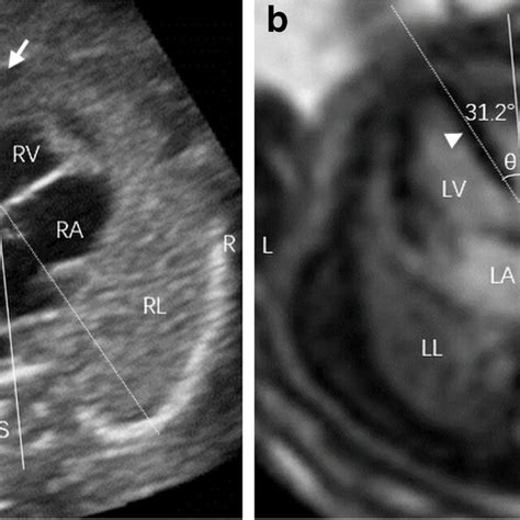 Fetal Cardiac Measurements In A 23 Week Normal Female Fetus A Fetal