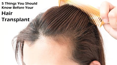 5 Things You Should Know Before Your Hair Transplant Dot Com Women