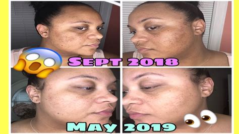 I Cleared My Cystic Acne My Face Routine Youtube