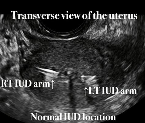 All about IUD or Intrauterine device. - Ultrasoundfeminsider