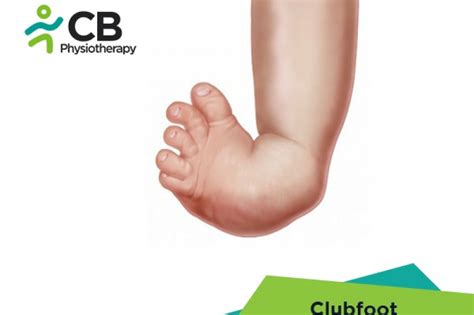 Congenital Clubfoot Surgery