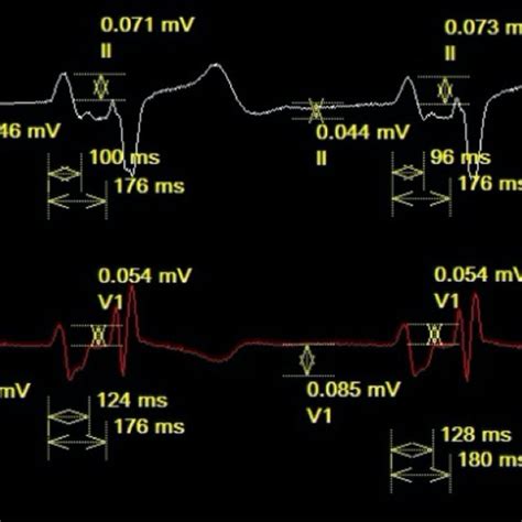 P wave measurements. Representative examples of how P wave measurements... | Download Scientific ...