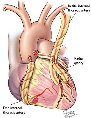 Coronary Artery Bypass Surgery