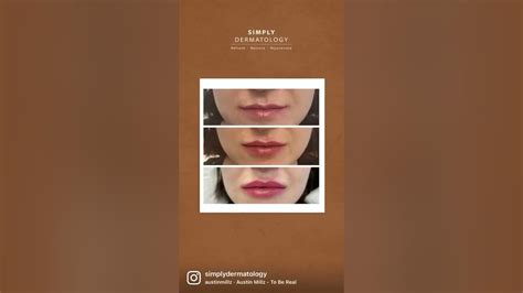 Lip Filler Progression Simply Dermatology Youtube