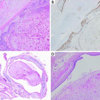 Microscopic Findings Of The Tumor A The Tumor Comprised A