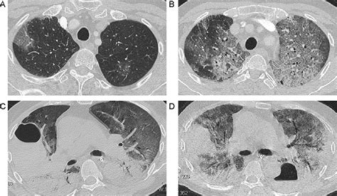 Hrct Features Of Pneumocystis Jiroveci Pneumonia And Their Evolution Before And After Treatment