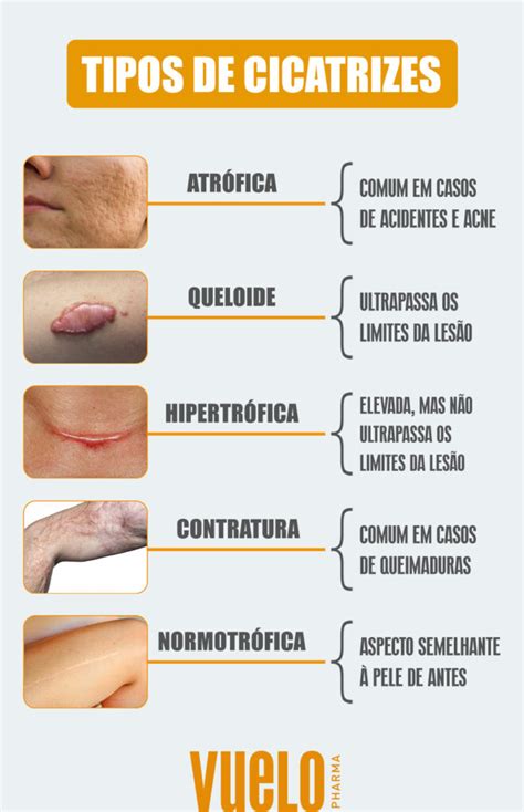 Cuidados Cicatrizes Prevenção Tratamentos e Dicas Essenciais