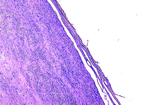 A Histology Hande Fibroma With A Fibrous Capsule Magnification ×100 Download Scientific