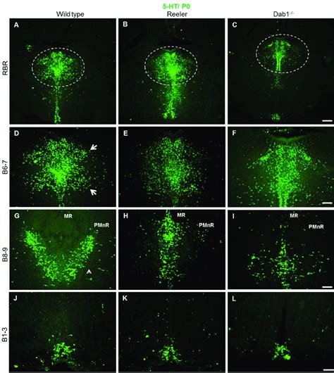 Altered Distribution Of Rostral Brainstem Serotonergic Raphe Nuclei But Download Scientific