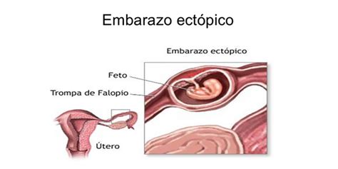 Todo Lo Que Debes Saber Del Embarazo EctÓpico Chequeos Ginecológicos