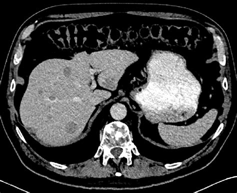 The Contrastenhanced Computed Tomography Scan Of The Abdomen Shows