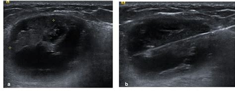 A Six Weeks Later The Patient Returned With Refilling Of The Lump Download Scientific