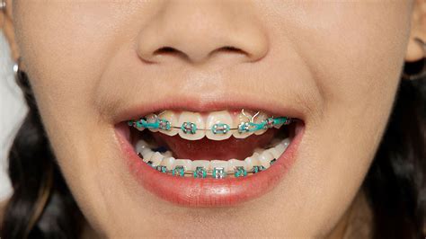 Braces With Rubber Bands Purpose And How Long They Stay On