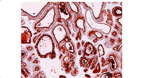 Immunohistochemical Features The Adenocarcinoma Component Is Strongly