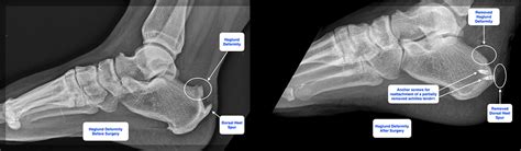 Haglund Deformity: Understanding Causes, Symptoms, and Treatments