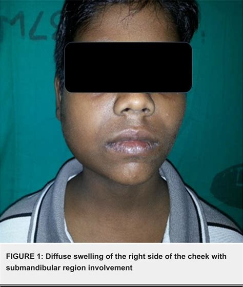 Figure 1 From Pediatric Primary Tuberculous Osteomyelitis Of The Mandible Mimicking Parotitis