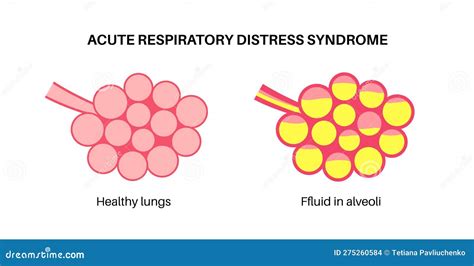 Ards Anatomical Poster Stock Vector Illustration Of Diagram 275260584