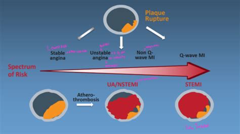 Nstemi Flashcards Quizlet