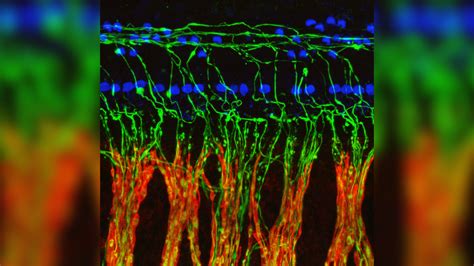 Tinnitus kann auf eine Nervenschädigung zurückzuführen sein bei