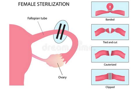 Female Sterilization Tubectomy Surgery In India Cost Hospitals Doctor