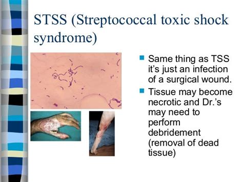 Toxic Shock Syndrome