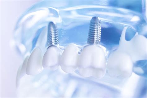 Navigating Dental Implant Side Effects What You Should Know Sargon