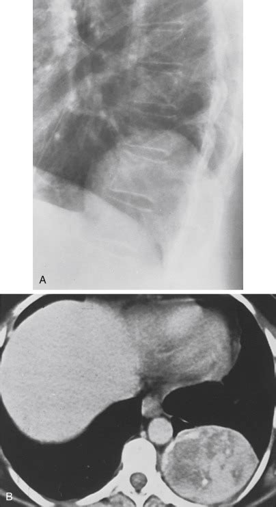 Pleural And Subpleural Opacities Radiology Key