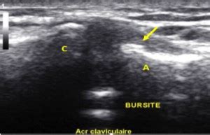 Bursite Acromio Claviculaire Adh Siolyse Manuelle Dynamique