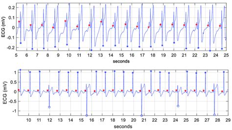 Ecg Strips With Detected Normal Heartbeats Blue Ectopic