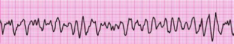 Acls Precourse Self Assessment Rhythms Flashcards Quizlet