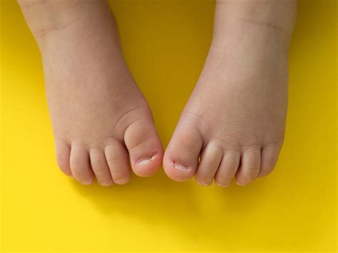 Childhood rashes and skin conditions: photos - BabyCenter Canada