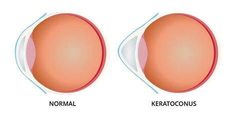 Keratoconus Specialist Near Me In Metro Detroit Normandy Optical