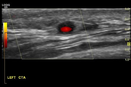 Temporal Artery Ultrasound