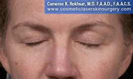 Under Eye Fraxel Laser Before And After Photos Dr Cameron Rokhsar