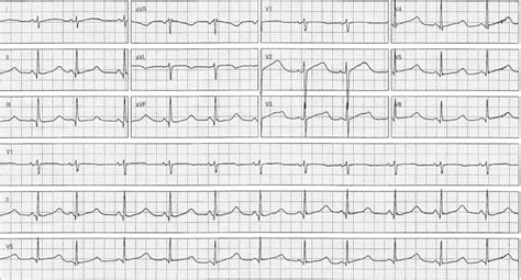 ECG Case 076 • LITFL • ECG Top 100 Self-Assessment Quiz