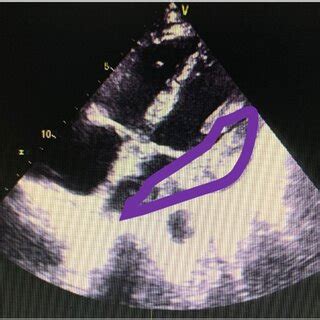 Echocardiography imaging: (A) parasternal long axis section; (B ...