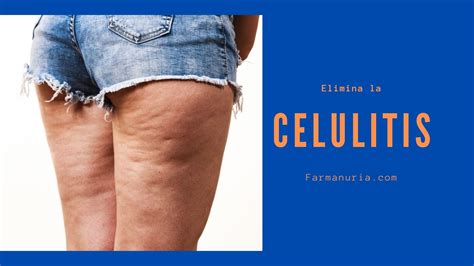 Como Eliminar La Celulitis O Piel De Naranja Farmacia Nuria Vanaclocha