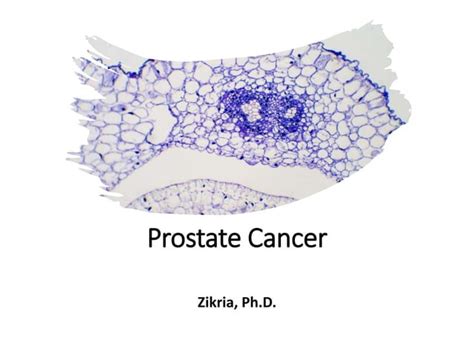 Prostate Cancerpptx For Healthcare Professionals Ppt