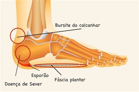 Dor No Calcanhar O Que Pode Ser E O Que Fazer Tua Sa De