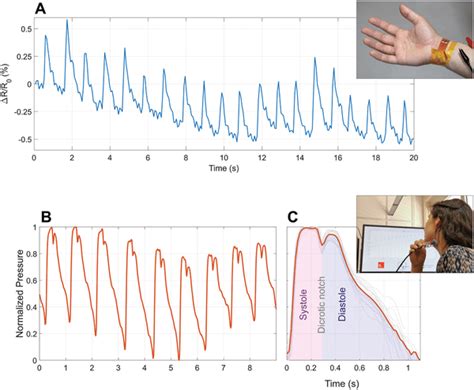 A Radial Pulse Detected Using An Hn Stripe Wrapped Around The Wrist