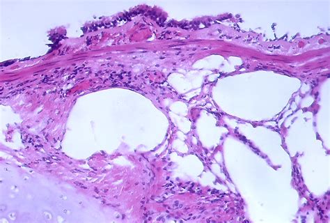 Bronchial Biopsy Exhibiting Air Bubble Artifact Flickr Photo Sharing